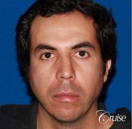 male patient with large chin augmentation - Before Image 1