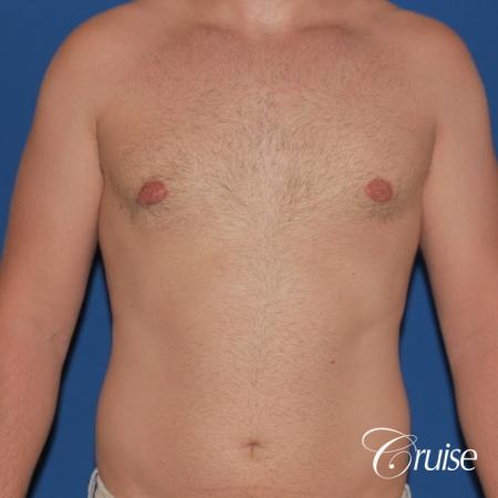 best puffy nipple surgery correction - After Image 1