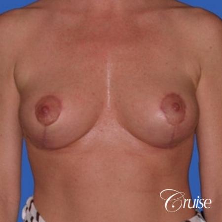no implants with breast lift anchor - After Image 1