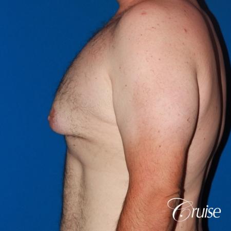 Severe Gynecomastia -Free Nipple Graft - Before and After Image 3