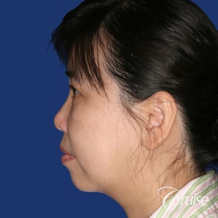 best chin implant photos with large implant - Before and After Image 2
