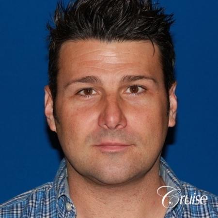 best medium terino square implant before and after pictures - After Image 1