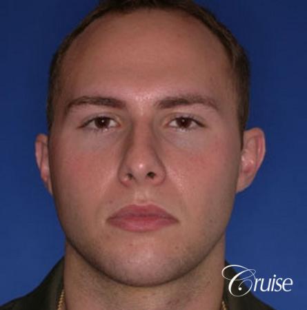 best chin implant on male with medium square jaw - After Image 1