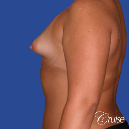 Breast Augmentation - Before Image 2