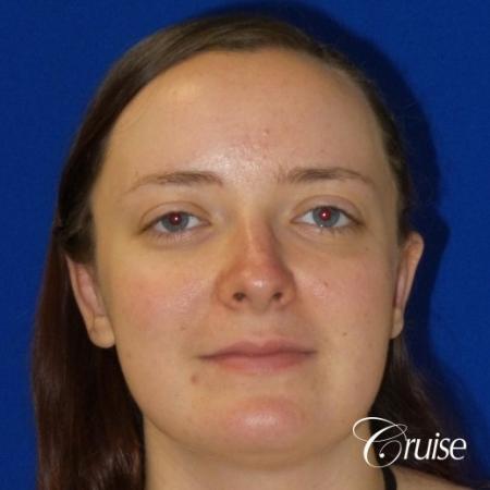 Otoplasty And Earlobe Repair: Patient 2 - After Image 1