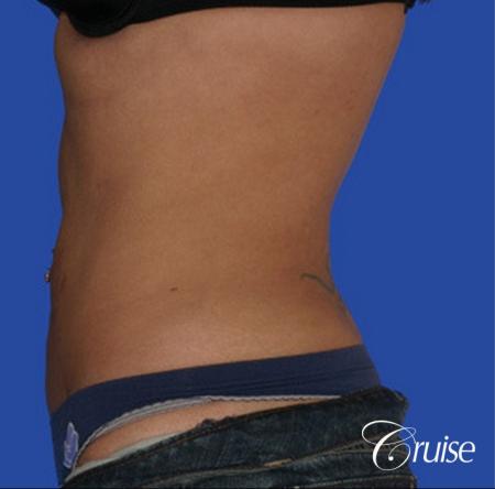 top plastic surgeon for liposuction in Newport Beach - After Image 2