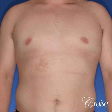 moderate gyne on teen with best pictures - After Image 1
