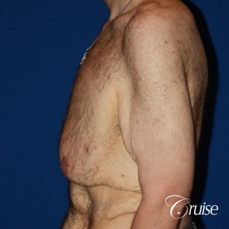 severe weight loss gynecomastia upper body lift - Before Image 3