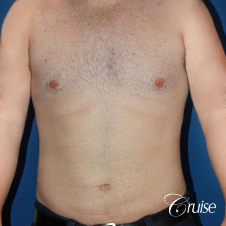 moderate chest gynecomastia and liposuction flanks - After Image 1