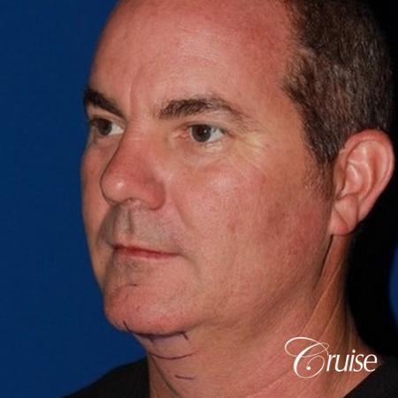 best pictures of chin augmentation with specialist - Before Image 3