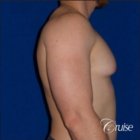 Dr. Cruise gynecomastia surgery photos - Before Image 4