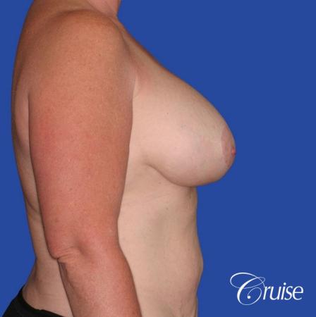 capsular contracture before and after pictures in Newport Beach - After 3