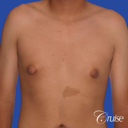 gynecomastia patient gets nipple reduction for best results - Before Image 1
