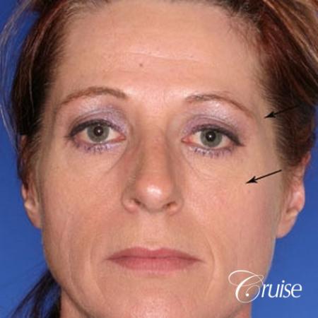 Amazing fat transfer results - Before Image
