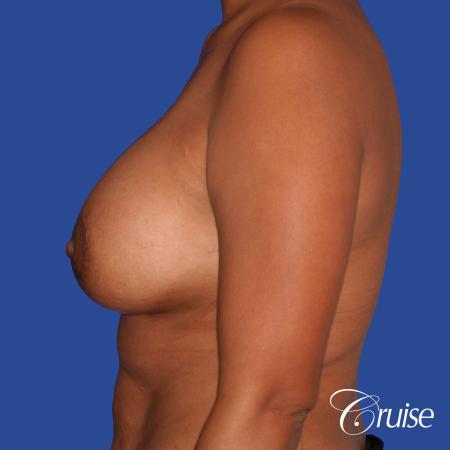 best breast lift donut with saline augmentation - After Image 2