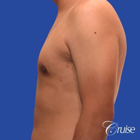 mild gynecomastia standard PA areola incision - After Image 2