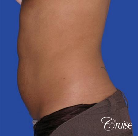 top plastic surgeon for liposuction in Newport Beach - Before Image 2