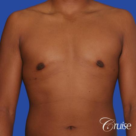 24 yr. old gets gynecomastia surgery with best scars - After Image 1
