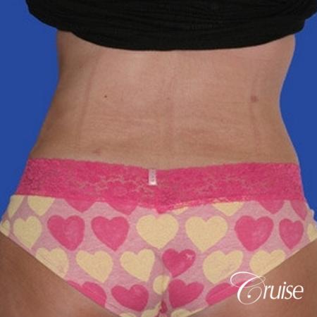 Liposuction: Patient 25 - After Image 3