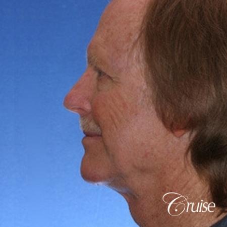 62 yr old with medium square chin augmentation - After Image 2