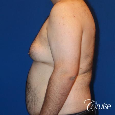 gynecomastia with free nipple graft - Before and After Image 3