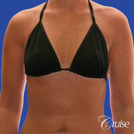 Breast Augmentation - Before Image 3