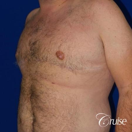 Severe Gynecomastia -Free Nipple Graft - After Image 2