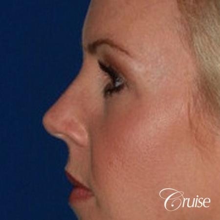 best upper eye lid results - After Image 3