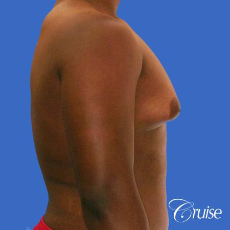 male breast moderate gynecomastia on young teen - Before and After Image 3