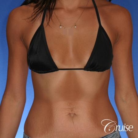 Breast Augmentation - Before and After 4