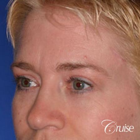 best specialist for upper eyelid surgery - After Image 3
