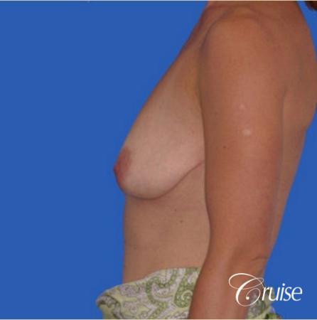 best breast lift anchor with silicone implants - Before and After Image 2