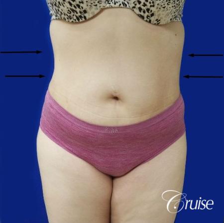 Best liposuction procedures dr cruise - After Image 1