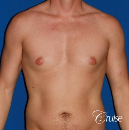 puffy nipple on 35 yr old male - Before Image 1