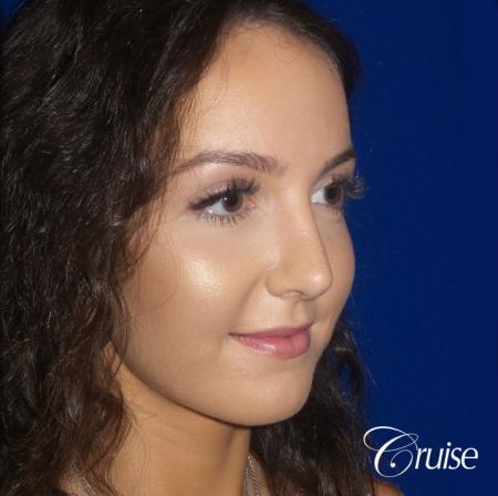 Rhinoplasty Dr. Cruise newport beach - After Image 2