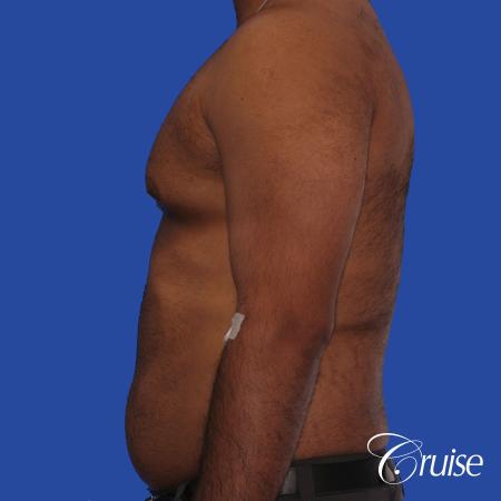 young adult with gyno gets gynecomastia surgery - Before Image 2