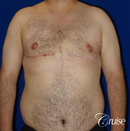 gynecomastia with free nipple graft - 1 After Image 1