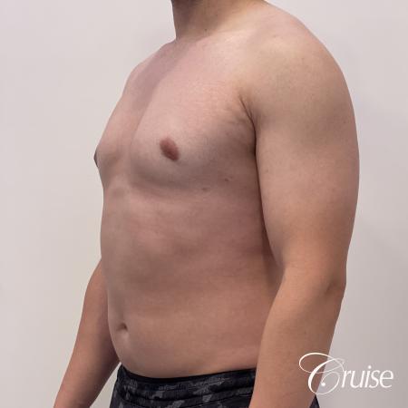 Gynecomastia: Patient 123 - After 2