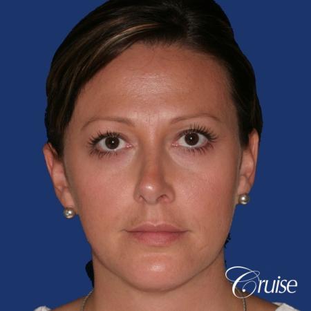 best before and after of chin augmentation medium implant - After Image 1