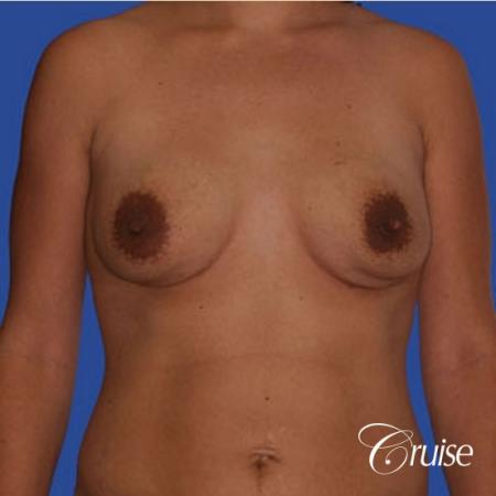 mini tummy tuck with silicone breast revision - Before Image 1