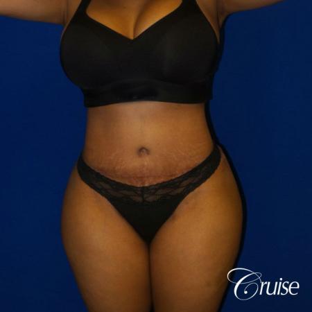 Best Tummy Tuck surgeons Newport Beach - After Image 1