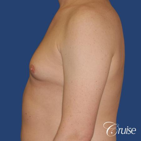 moderate gynecomastia on adult with donut lift scar - Before and After Image 2
