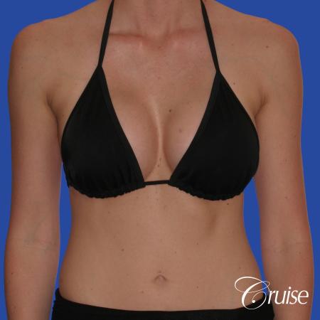Breast Augmentation - After Image 4