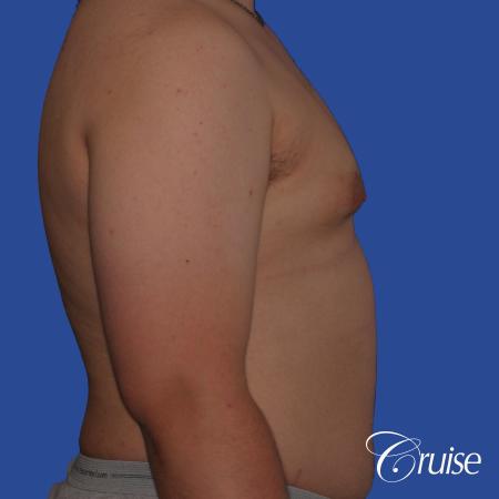 best scars for moderate gynecomastia - Before and After Image 3