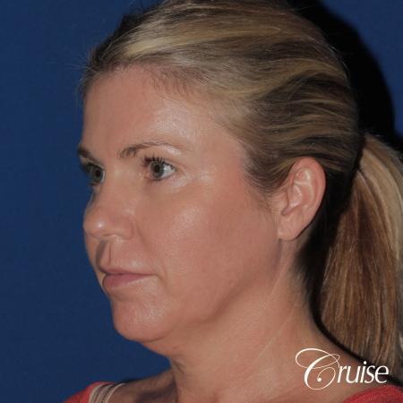 best small anatomic implant photos - Before Image 3