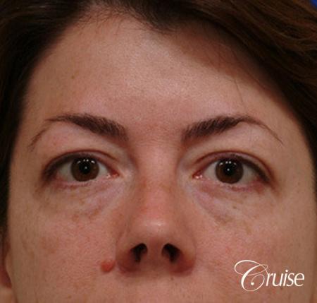blepharoplasty specialist - Before Image 1