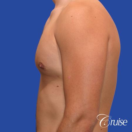 24 yr old body builder mild gynecomastia - After Image 2