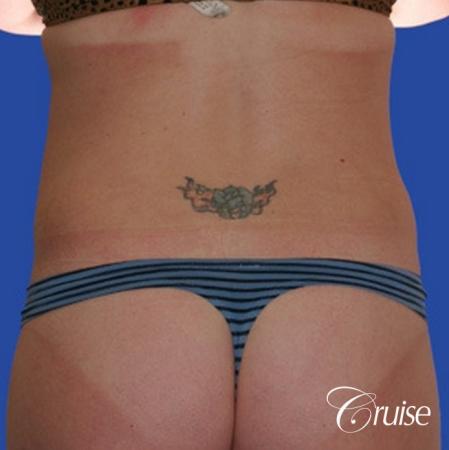 best skinny abs from liposuction abdomen and flanks - After Image 2