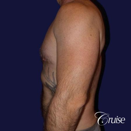 Moderate Gynecomastia -Areola Incision - After Image 5