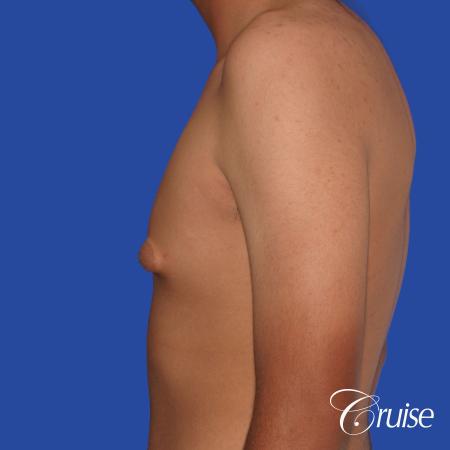 gynecomastia patient gets nipple reduction for best results - Before Image 2